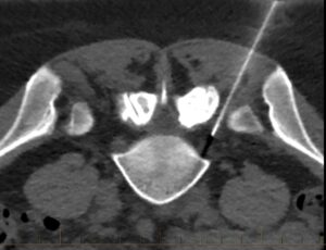 CT Guided Spinal Injections , Gold Coast - Panorama Radiology Specialists