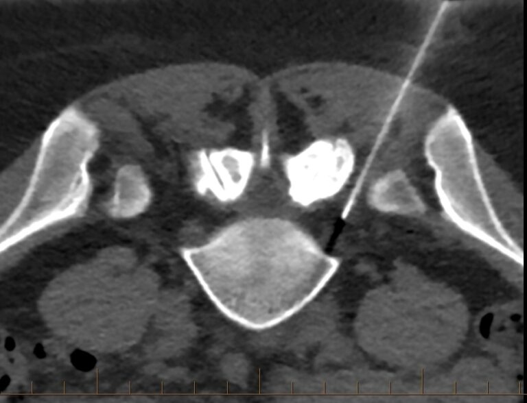 CT Guided Spinal Injections , Gold Coast Panorama Radiology Specialists