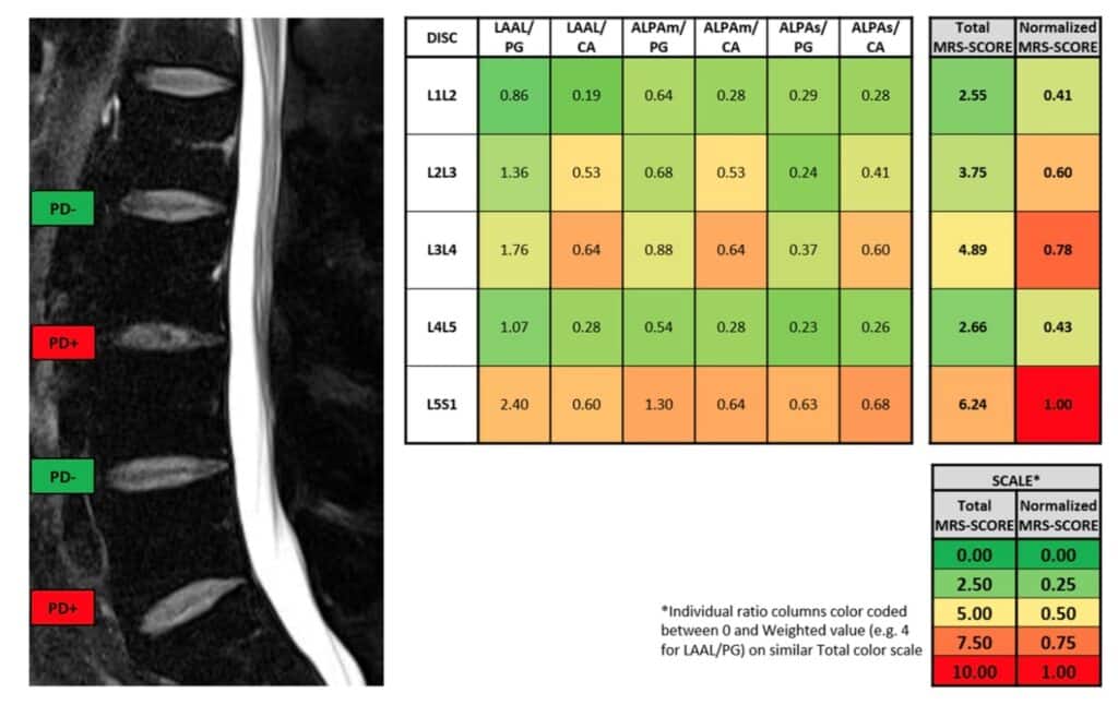 MRI Disc Spectroscopy - the MRS Score from 0 to 1 indicates the relative content of pain-generating compounds such as Lactate within a disc