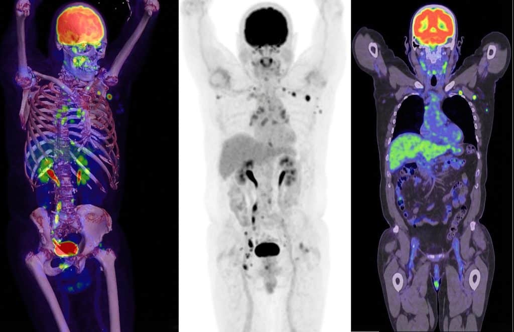 PET scan gold coast